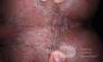 Fístula anal 1 semana después de la fistulotomía