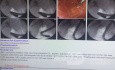 Nuevo caso de biopsia directa con fórceps fríos de la parte proximal de colangiocarcinoma de CBC bajo fluoroscopia