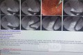 Nuevo caso de biopsia directa con fórceps fríos de la parte proximal de colangiocarcinoma de CBC bajo fluoroscopia