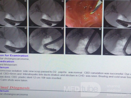 Nuevo caso de biopsia directa con fórceps fríos de la parte proximal de colangiocarcinoma de CBC bajo fluoroscopia