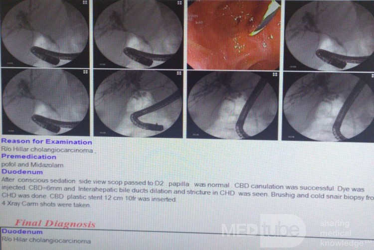 Nuevo caso de biopsia directa con fórceps fríos de la parte proximal de colangiocarcinoma de CBC bajo fluoroscopia