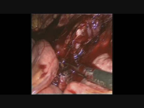 Control laparoscópico del sangrado aórtico después de una linfadenectomía paraórtica laparoscópica para el cáncer de colon izquierdo