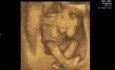 Imagen de ultrasonido del movimiento del bebé