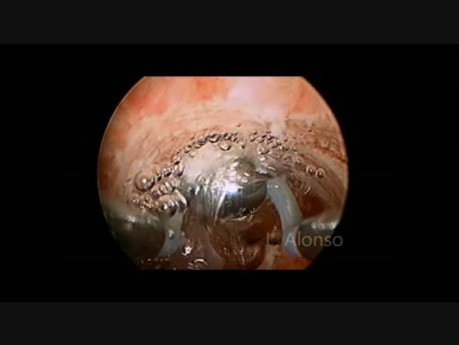 Corrección histeroscópica de istmocele