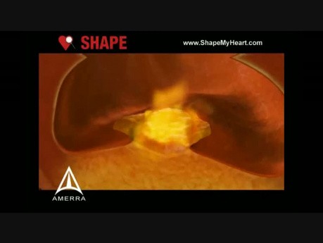 SHAPE - Anuncio de servicio público de ataque cardíaco - Animación médica en 3D
