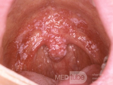 Candidiasis oral [aftas] 