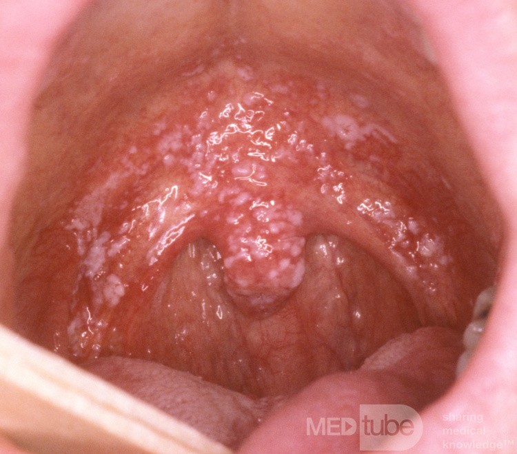 Candidiasis oral [aftas] 