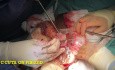 Extracción de fibromas