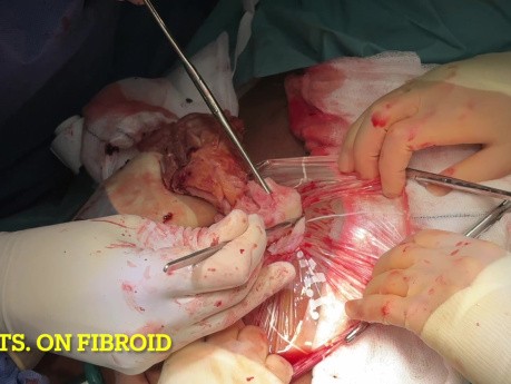 Extracción de fibromas