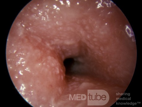 Otitis externa alérgica grave