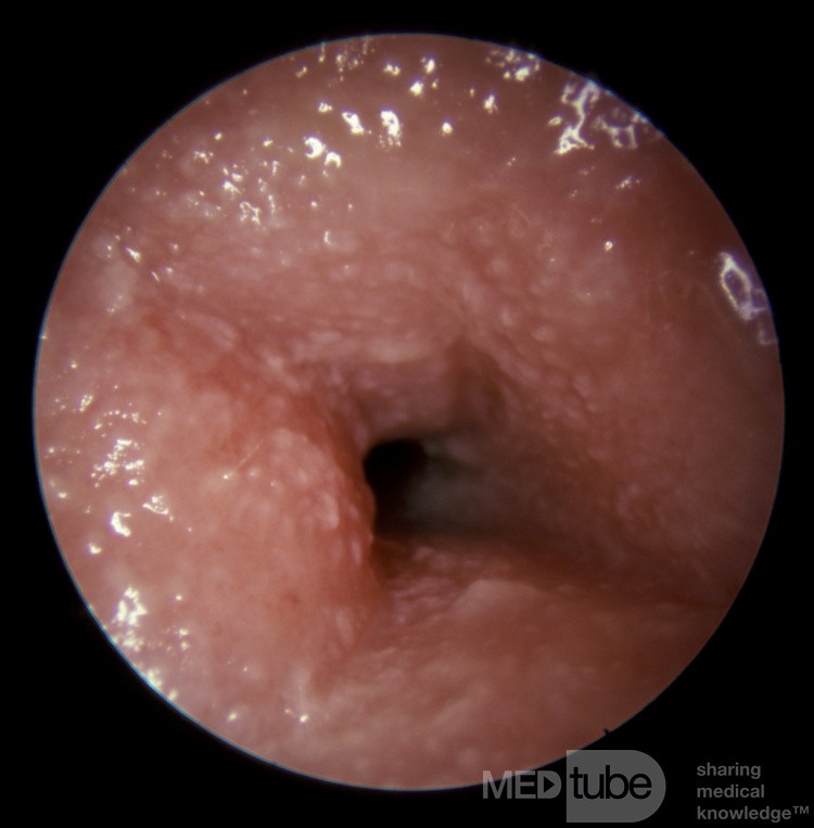 Otitis externa alérgica grave