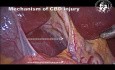 Mecanismo de lesión del conducto biliar común