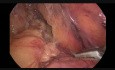 Colectomía izquierda laparoscópica para el carcinoma de flexión esplénica