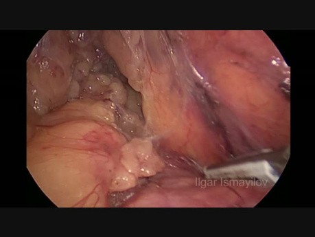 Colectomía izquierda laparoscópica para el carcinoma de flexión esplénica