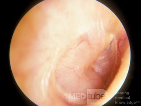 Neuroma acústico del oído medio