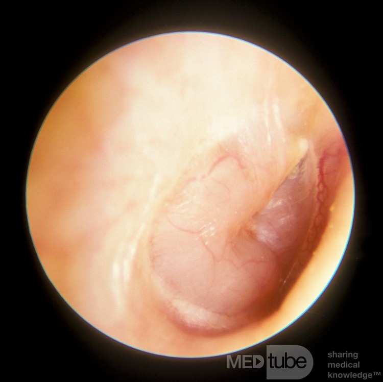 Neuroma acústico del oído medio