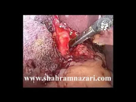 Exploración laparoscópica del conducto biliar común, técnica de extracción de cálculos con fórceps