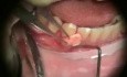 Implantes en periodontología - microcirugía