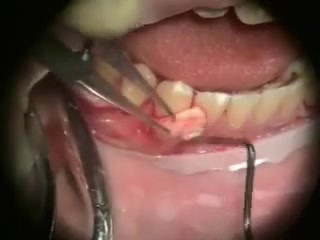 Implantes en periodontología - microcirugía