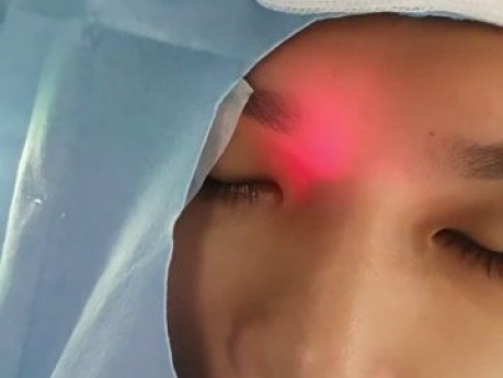 Iluminación del seno frontal mediante guía de luz para sinuplastia con balón