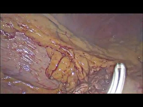 Esplenopancreatectomía izquierda laparoscópica