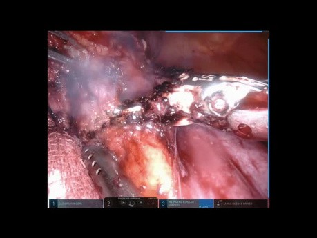 Teratoma mediastínico (cirugía robótica)