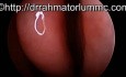 Perforación de un tabique nasal [agujero en la partición de la cavidad nasal] en HD
