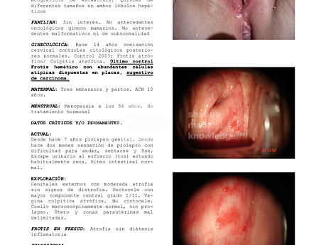 Menopausia Citologia Carcinoma Estrogenos Citologia Normal