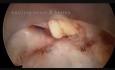 Discectomía endoscópica lumbar 