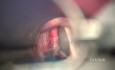 Revisión quirúrgica de un cáncer de cuerdas vocales