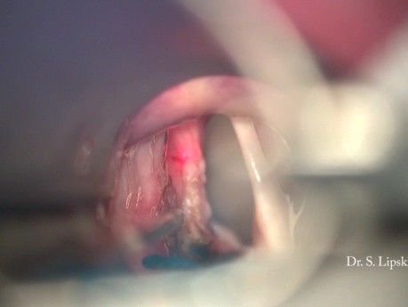 Revisión quirúrgica de un cáncer de cuerdas vocales