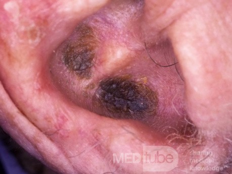 Descuidar la queratosis