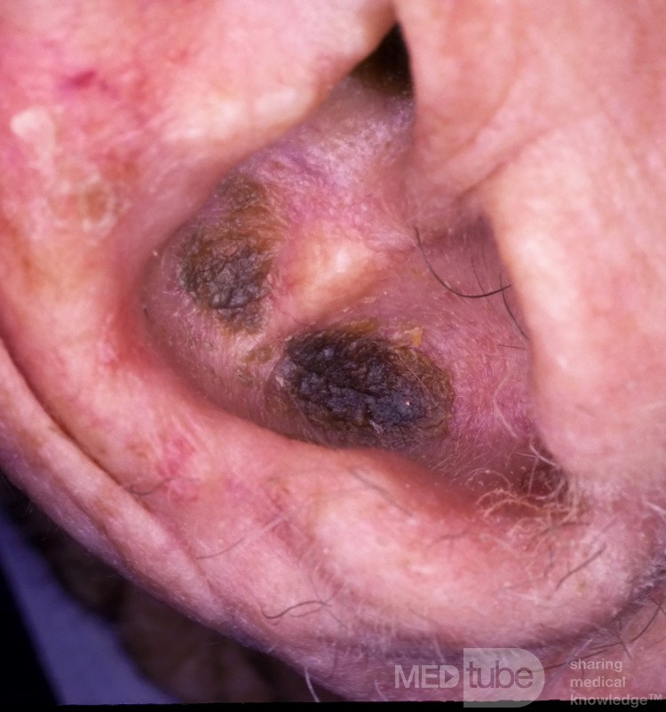 Descuidar la queratosis