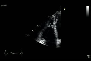Ecocardiograma en cámara lenta