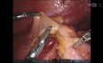 Uso de verde de indocianina (ICG) en cirugía colorrectal mediante robot en anastomosis colorrectal baja