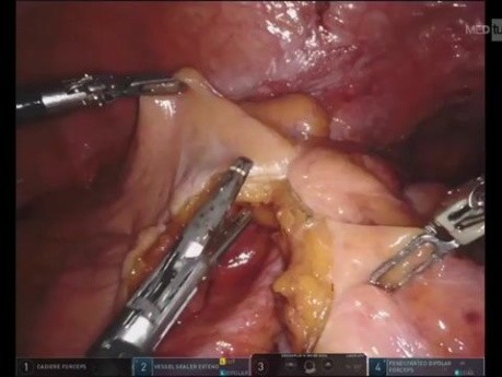 Uso de verde de indocianina (ICG) en cirugía colorrectal mediante robot en anastomosis colorrectal baja