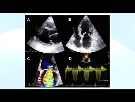 Evaluación ecocardiográfica de la cardiopatía reumática