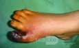 Gangrena seca del dedo gordo del pie - isquemia
