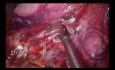 Segmentectomía anterobasal anatómica izquierda VATS Uniportal S8 (cirugía en vivo a Milán durante la EACTS)