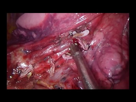 Segmentectomía anterobasal anatómica izquierda VATS Uniportal S8 (cirugía en vivo a Milán durante la EACTS)