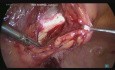 Histerectomía total por vía laparoscópica junto con pectopexia por un prolapso genital