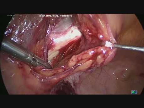 Histerectomía total por vía laparoscópica junto con pectopexia por un prolapso genital