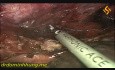 Esofagectomía toracolaparoscópica en posición prona con linfadenectomía mediastínica total