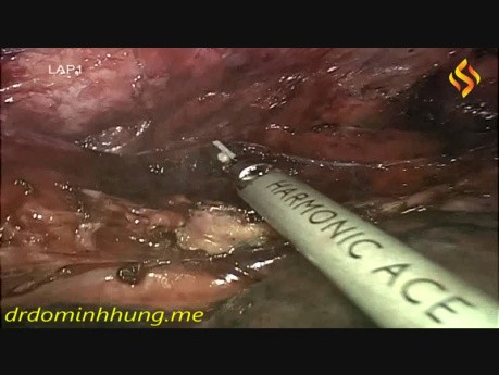 Esofagectomía toracolaparoscópica en posición prona con linfadenectomía mediastínica total