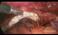 Técnica de tracción peritoneal de vaginoplastia laparoscópica en útero ausente
