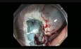 Complicaciones de la resección mucosa endoscópica (RME) - sangrado en colon ascendente - caso 1B