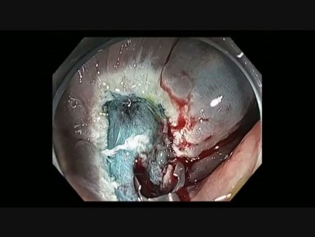 Complicaciones de la resección mucosa endoscópica (RME) - sangrado en colon ascendente - caso 1B