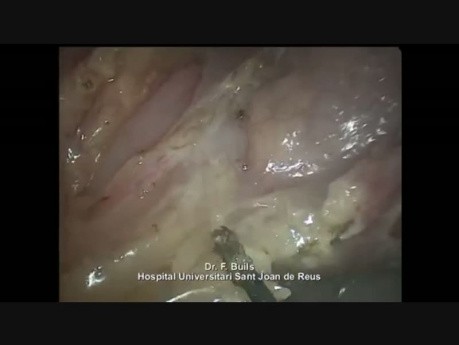 Tratamiento laparoscópico de un divertículo yeyunal perforado 