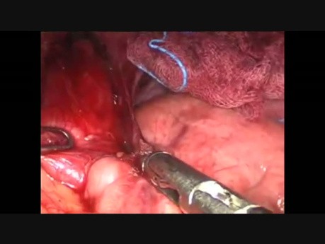 Miotomía de Heller laparoscópica