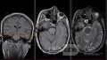Estirpación de cavernoma subcortical 